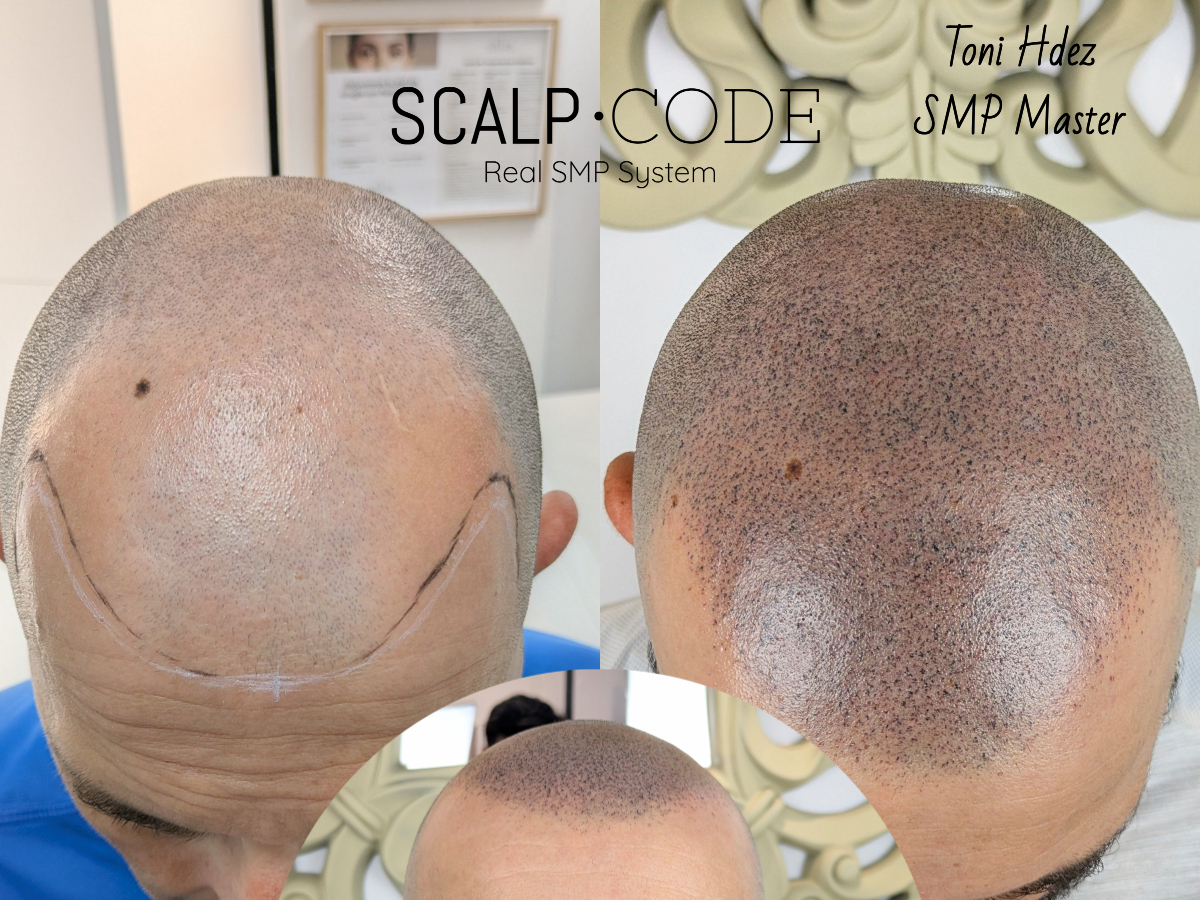 Tecnica Hiperrealista Scalp Code formación micro capilar Alicante